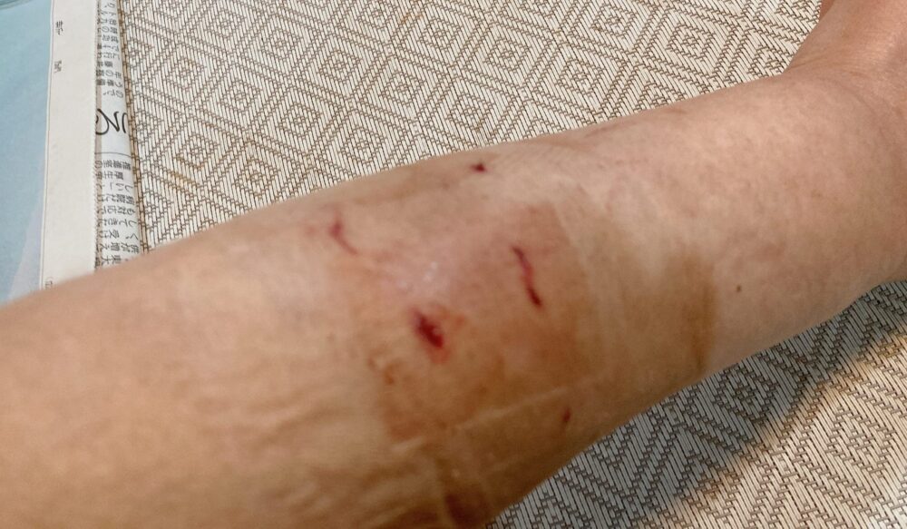 猫に噛まれた！激痛が走った後、傷は10箇所も。筋肉近くまで達しているのもあった。